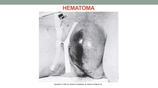 HEMATOMA
 