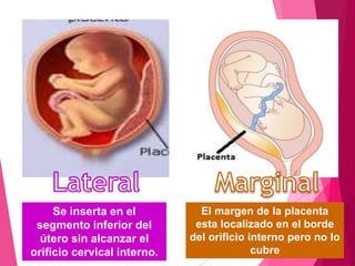 El orificio interno esta
completamente cubierto
por el tejido placentario
Placenta previa oclusiva:
Superficie placentaria...
