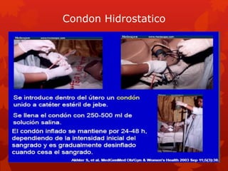 TÉCNICA DE HAYMAN 
Hayman R. Uterine compression sutures: surgical management of 
postpartum hemorrhage. Obstet Gynecol 20...