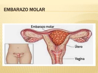 EMBARAZO MOLAR
 