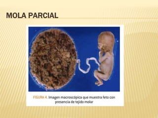 MOLA PARCIAL
 