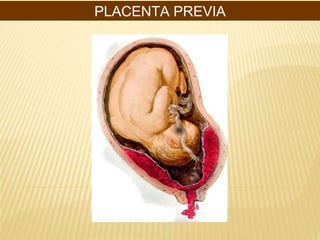 PLACENTA PREVIA
 
