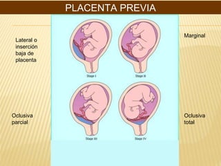 PLACENTA PREVIA
Marginal
Lateral o
inserción
baja de
placenta
Oclusiva
parcial
Oclusiva
total
 