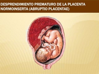 DESPRENDIMIENTO PREMATURO DE LA PLACENTA
NORMOINSERTA (ABRUPTIO PLACENTAE)
 