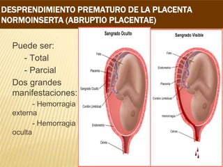 DESPRENDIMIENTO PREMATURO DE LA PLACENTA
NORMOINSERTA (ABRUPTIO PLACENTAE)
Puede ser:
- Total
- Parcial
Dos grandes
manifestaciones:
- Hemorragia
externa
- Hemorragia
oculta
 