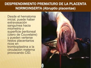 FISIOPATOLOGIA
Desde el hematoma
inicial, puede haber
extravasación
sanguínea hacia
miometrio y
superficie peritoneal
(útero de Couvelaire)
y pueden verterse
restos placentarios
ricos en
tromboplastina a la
circulación materna
provocando CID.
DESPRENDIMIENTO PREMATURO DE LA PLACENTA
NORMOINSERTA (Abruptio placentae)
 