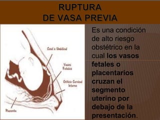 Es una condición
de alto riesgo
obstétrico en la
cual los vasos
fetales o
placentarios
cruzan el
segmento
uterino por
debajo de la
presentación.
 