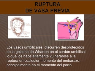 Los vasos umbilicales discurren desprotegidos
de la gelatina de Wharton en el cordón umbilical
lo que los hace altamente vulnerables a la
ruptura en cualquier momento del embarazo,
principalmente en el momento del parto.
 