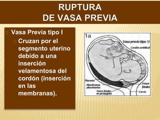 TIPOS.
Vasa Previa tipo I
Cruzan por el
segmento uterino
debido a una
inserción
velamentosa del
cordón (inserción
en las
membranas).
 