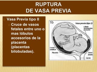 Vasa Previa tipo II
Cruce de vasos
fetales entre uno o
mas lóbulos
accesorios de la
placenta
(placentas
bilobuladas).
 