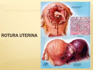 ROTURA UTERINA
 
