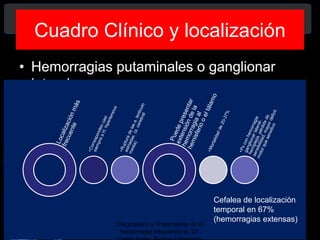 Cuadro Clínico y localización
• Hemorragias putaminales o ganglionar
laterales.
Cefalea de localización
temporal en 67%
(hemorragias extensas)
Diagnóstico y Tratamiento de la
hemorragia intracerebral. Dr.
 