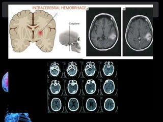 Diagnóstico y Tratamiento de la
hemorragia intracerebral. Dr.
 