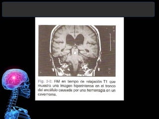 Diagnóstico y Tratamiento de la
hemorragia intracerebral. Dr.
 