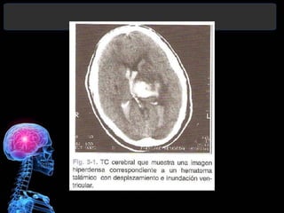 Diagnóstico y Tratamiento de la
hemorragia intracerebral. Dr.
 