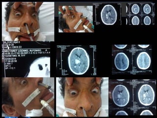 Diagnóstico y Tratamiento de la
hemorragia intracerebral. Dr.
 