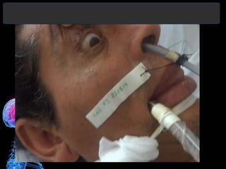 Diagnóstico y Tratamiento de la
hemorragia intracerebral. Dr.
 