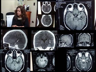 Diagnóstico y Tratamiento de la
hemorragia intracerebral. Dr.
 