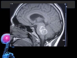 Diagnóstico y Tratamiento de la
hemorragia intracerebral. Dr.
 