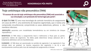 HEMORRAGIA PÓS-PARTO
portaldeboaspraticas.iff.fiocruz.br
Traje antichoque não pneumático (TAN)
O QUE É O TAN ? É uma nova tecnologia de controle transitório do sangramento
em casos de HPP. É uma vestimenta de neoprene segmentada, que e realiza uma
compressão circunferencial, comprimindo os vasos abdominais, pélvicos e dos
membros inferiores
“O sucesso do uso do traje antichoque não pneumático (TAN) está associado a
sua vinculação a um protocolo de hemorragia pós parto”.
BENEFÍCIOS: O TAN reduz o sangramento local e redireciona o fluxo para as partes
superiores nobres do organismo. Tal efeito pode determinar tempo adicional até o
tratamento definitivo ( útil em transferências).
CUIDADOS : O TAN deve ser posicionado no sentido do segmento 1 ao segmento 6. Sua
retirada deve ser gradual, na mesma sequencia (do segmento 1 ao 6) e sob
monitoramento contínuo pelo risco de reativação do sangramento e choque.
INDICAÇÃO: pacientes com instabilidade hemodinâmica ou em iminência de choque
hipovolêmico
OPAS 2018, FLASOG 2018
www.viaglobalhealth.com/product/non-
pneumatic-anti-shock-garment/
 