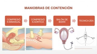 MANIOBRAS DE CONTENCIÓN
COMPRESIÓ
N BIMANUAL
COMPRESIÓ
N AÓRTICA
BALÓN DE
BAKRI
TECNICA ZEA
 