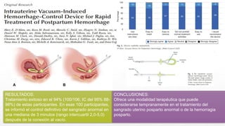 RESULTADOS:
Tratamiento exitoso en el 94% (100/106, IC del 95% 88-
98%) de estas participantes. En esas 100 participantes,
se informó el control definitivo del sangrado anormal en
una mediana de 3 minutos (rango intercuartil 2,0-5,0)
después de la conexión al vacío.
CONCLUSIONES:
Ofrece una modalidad terapéutica que puede
considerarse tempranamente en el tratamiento del
sangrado uterino posparto anormal o de la hemorragia
posparto.
 