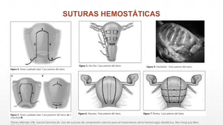 SUTURAS HEMOSTÁTICAS
Flores-Méndez VM, García-Sánchez JA. Uso de suturas de compresión uterina para el tratamiento de la hemorragia obstétrica. Rev Hosp Jua Mex.
 