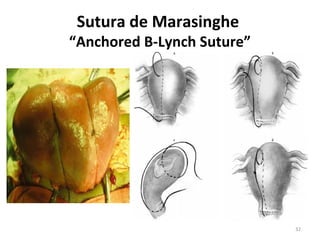 Sutura de Marasinghe

“Anchored B-Lynch Suture”

32

 