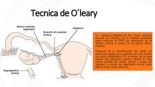 Tecnica de O´leary
La ligadura bilateral de los vasos uterinos
(sutura de O'Leary) es el método preferido
para controlar la HPP por laceración de la
arteria uterina o ramas de la arteria útero-
ovárica.
Después de la identificación del uréter, se
pasa una aguja curva grande con una sutura
de ácido poliglicólico # 0 a través de la cara
lateral del segmento uterino inferior lo más
cerca posible del cuello uterino y luego de
regreso a través del ligamento ancho justo
lateral a los vasos uterinos.
 