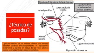 ¿Técnica de
posadas?
Ligadura selectiva de las arterias uterinas con abordaje
posterior (técnica Posadas),consiste en laparotomía
exploradora y ligadura en bloque de los vasos uterinos
(arteria y vena) por la cara posterior del útero.
 