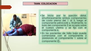 TANN. COLOCACION
• Se inicia por la porción distal,
simultáneamente ambos componentes
de cada pierna del 1 al 3, luego el
componente pélvico(4) y, finalmente, la
bola del componente 5 se acopla sobre
el cuerpo uterino y se fija con el
componente 6.
• En las pacientes de talla baja puede
comenzarse con el componente 2
(doblando el componente 1 sobre el
componente 2).
 