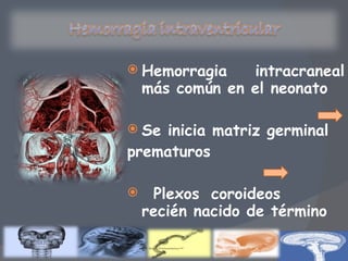 Hemorragia intracraneal más común en el neonato Se inicia matriz germinal prematuros Plexos coroideos recién nacido de término 