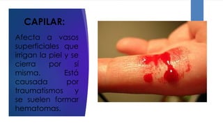 CAPILAR:
Afecta a vasos
superficiales que
irrigan la piel y se
cierra por sí
misma. Está
causada por
traumatismos y
se suelen formar
hematomas.
 