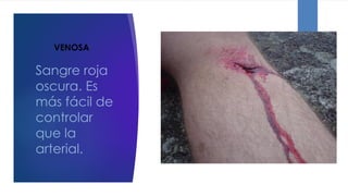 VENOSA:
Sangre roja
oscura. Es
más fácil de
controlar
que la
arterial.
 