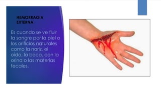 HEMORRAGIA
EXTERNA
Es cuando se ve fluir
la sangre por la piel o
los orificios naturales
como la nariz, el
oído, la boca, con la
orina o las materias
fecales.
 