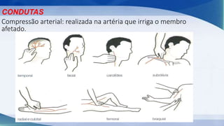 CONDUTAS
Compressão arterial: realizada na artéria que irriga o membro
afetado.
 