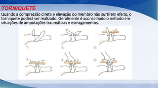TORNIQUETE
Quando a compressão direta e elevação do membro não surtirem efeito, o
torniquete poderá ser realizado. Geralmente é aconselhado o método em
situações de amputações traumáticas e esmagamentos.
 