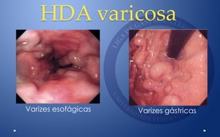 HDA varicosa
Varizes esofágicas Varizes gástricas
 
