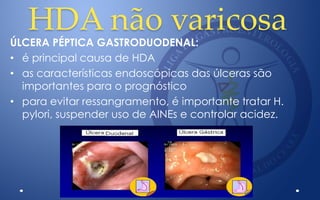 HDA não varicosa
ÚLCERA PÉPTICA GASTRODUODENAL:
• é principal causa de HDA
• as características endoscópicas das úlceras são
importantes para o prognóstico
• para evitar ressangramento, é importante tratar H.
pylori, suspender uso de AINEs e controlar acidez.
 