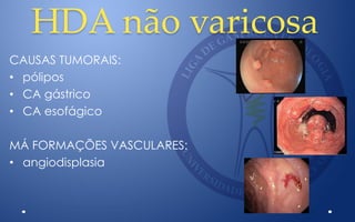 HDA não varicosa
CAUSAS TUMORAIS:
• pólipos
• CA gástrico
• CA esofágico
MÁ FORMAÇÕES VASCULARES:
• angiodisplasia
 