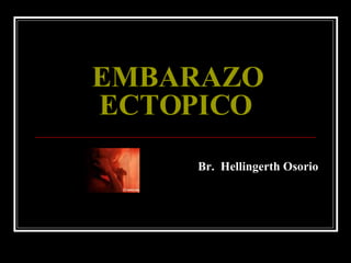 EMBARAZO ECTOPICO Br.  Hellingerth Osorio 