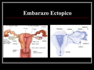 Embarazo Ectopico 