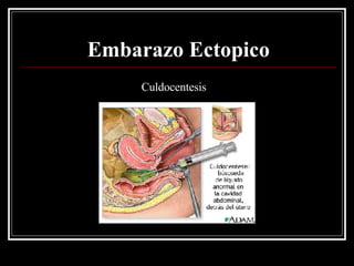 Embarazo Ectopico Culdocentesis 