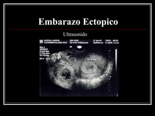 Embarazo Ectopico Ultrasonido 