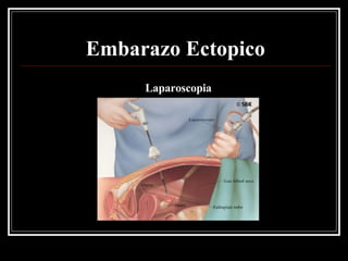 Embarazo Ectopico Laparoscopia 