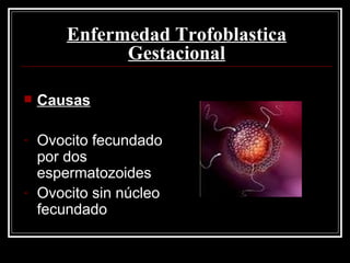 Enfermedad Trofoblastica Gestacional Causas Ovocito fecundado por dos espermatozoides Ovocito sin núcleo fecundado 