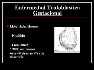 Mola Hidatififorme - Hidátide -  Frecuencia: 1/1000 embarazos Asia – Países en Vías de desarrollo  Enfermedad Trofoblastica Gestacional 