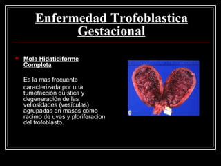 Enfermedad Trofoblastica Gestacional Mola Hidatidiforme Completa Es la mas frecuente caracterizada por una tumefacción quística y degeneración de las vellosidades (vesículas) agrupadas en masas como racimo de uvas y ploriferacion del trofoblasto.  