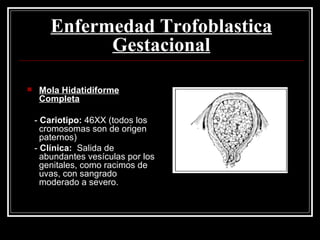 Mola Hidatidiforme Completa -  Cariotipo:  46XX (todos los cromosomas son de origen paternos) -  Clínica:   Salida de abundantes vesículas por los genitales, como racimos de uvas, con sangrado moderado a severo. Enfermedad Trofoblastica Gestacional 