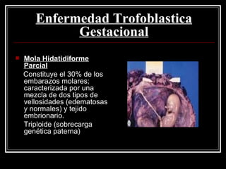 Enfermedad Trofoblastica Gestacional Mola Hidatidiforme Parcial Constituye el 30% de los embarazos molares; caracterizada por una mezcla de dos tipos de vellosidades (edematosas y normales) y tejido embrionario. Triploide   (sobrecarga genética paterna) 